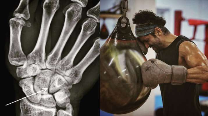 Farhan Akhtar suffers from 'boxing injury' while shooting